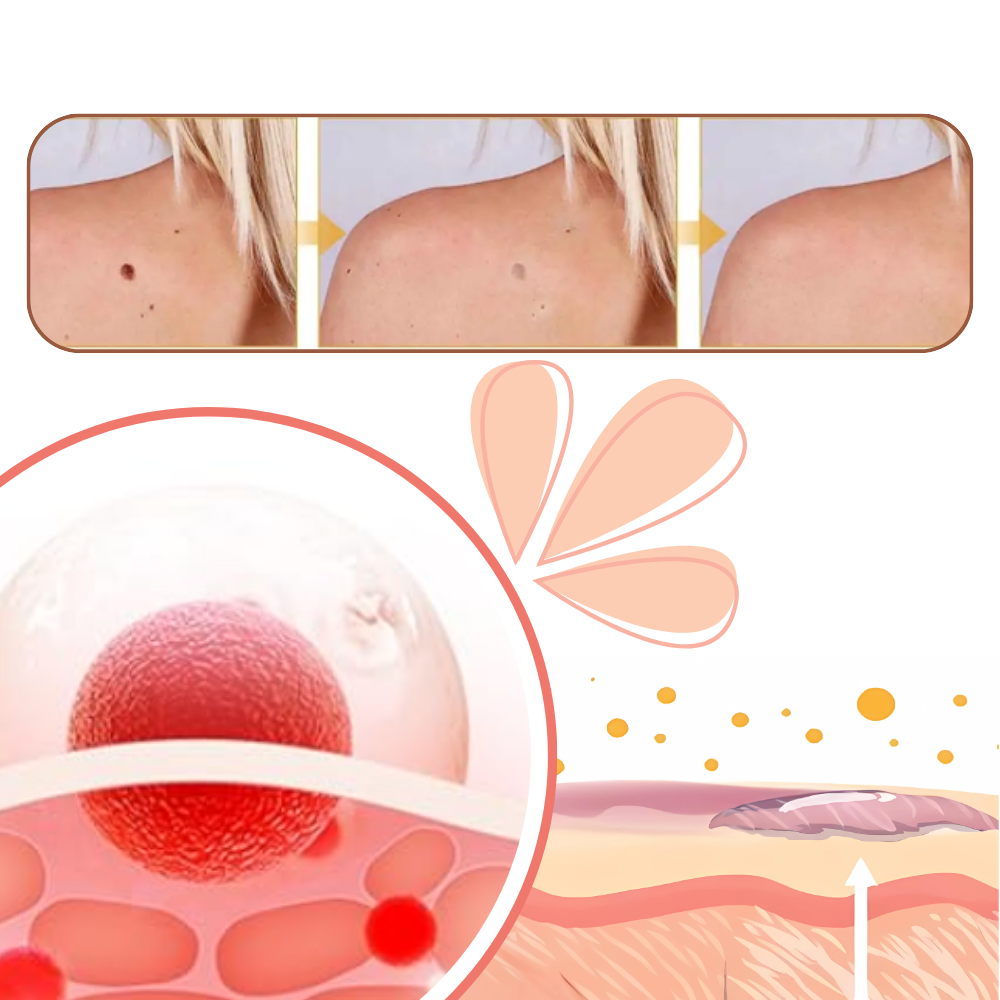 Rimuovi Escrescenze Cutanee Non-Invasivo - Ozerty