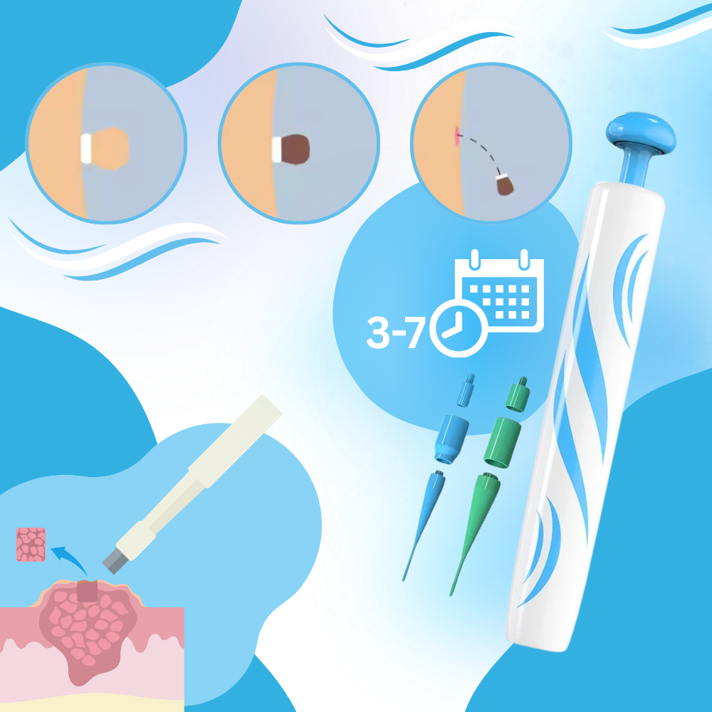 Tecnica di legatura per la rimozione - Ozerty