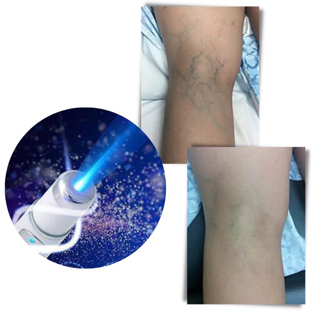 Penna per la terapia della pelle a luce blu - Ozerty