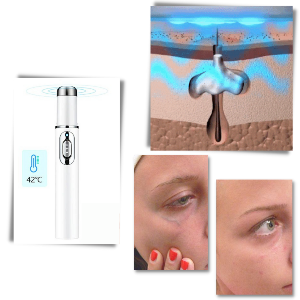 Penna per la terapia della pelle a luce blu - Ozerty