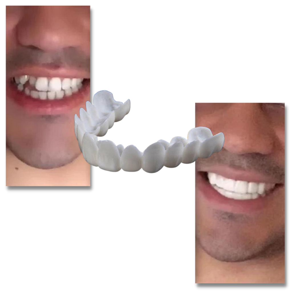 Copertura dentale del sorriso perfetto - faccette confortevoli - Ozerty
