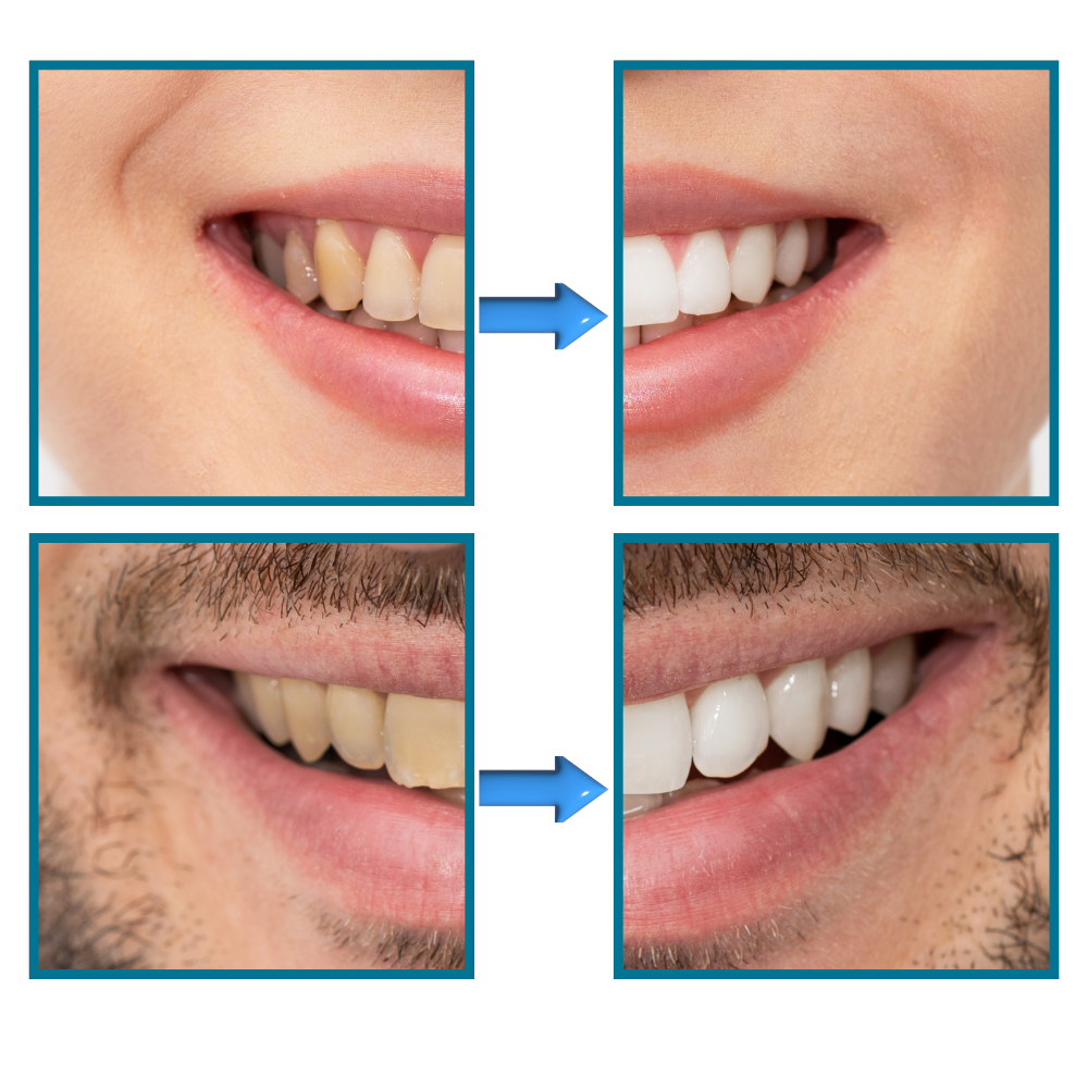 Sbiancamento rapido dei denti - Ozerty