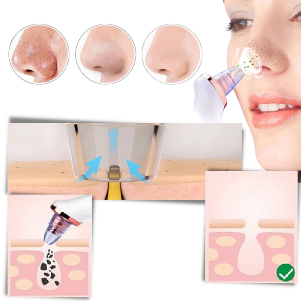 Aspiratore per punti neri - Ozerty